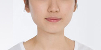 面部吸脂術(shù)前