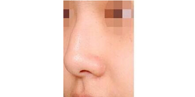 駝峰鼻矯正術(shù)前