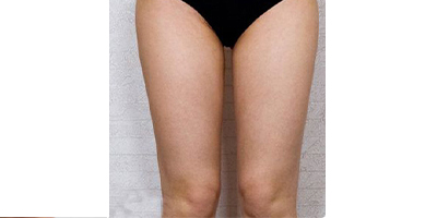 動氧瘦大腿術(shù)后