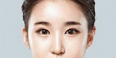 顴骨顴弓整形術(shù)術(shù)后