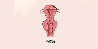 手術(shù)緊縮陰道術(shù)前