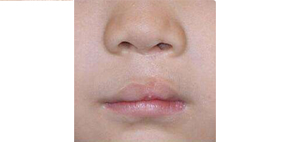 唇腭裂手術(shù)術(shù)后