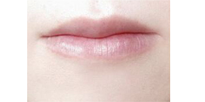 自體脂肪豐唇術前