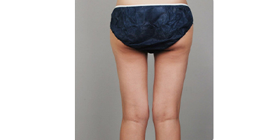 動(dòng)氧瘦臀部術(shù)后