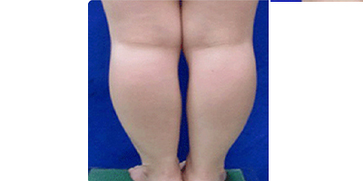 共振吸脂術(shù)術(shù)前