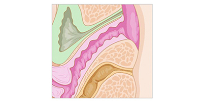 激光緊縮陰道術后