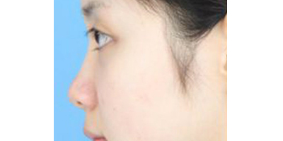 鼻部多項(xiàng)術(shù)前