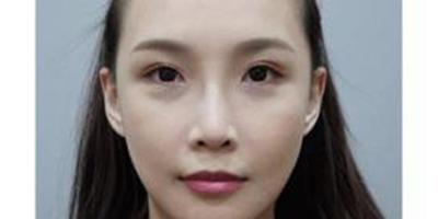 自體真皮隆鼻術(shù)后