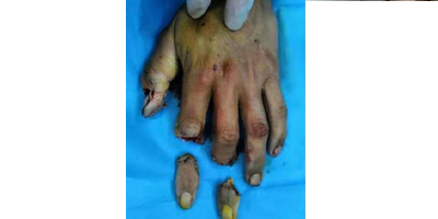 手指斷指再造術(shù)前