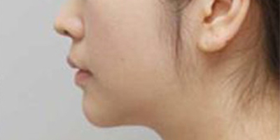 膨體墊下巴術(shù)后