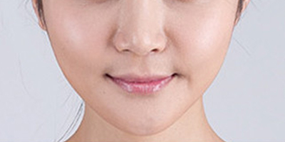 曼特波隆下巴術后