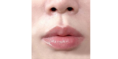 人中縮短術(shù)術(shù)后