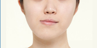 面部不對稱矯正術前