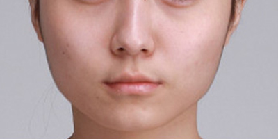 曼特波隆下巴術前