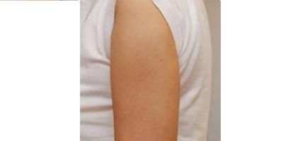 動(dòng)氧瘦手臂術(shù)后