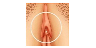 陰蒂整形術術前