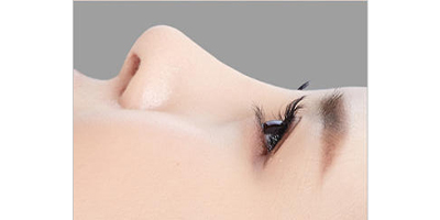 超體隆鼻術(shù)后