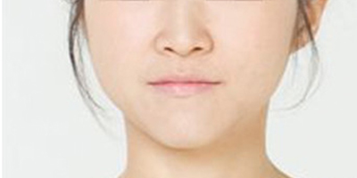 光纖溶脂瘦臉術(shù)后