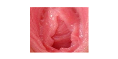 處女膜修復術(shù)前