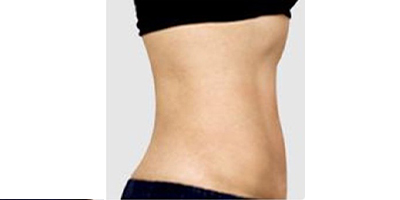 腹壁成形術(shù)術(shù)后