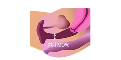 私密超聲提升術后