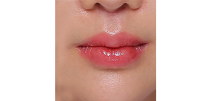 唇部綜合術(shù)后