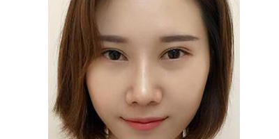 鼻中隔軟骨隆鼻術(shù)后