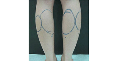 小腿吸脂術(shù)前
