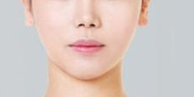 下頜角整形術后