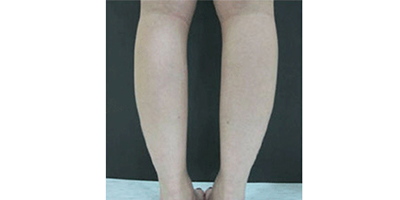 小腿吸脂術(shù)后