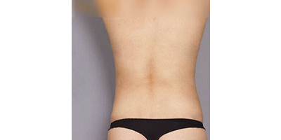 按摩減肥術(shù)后