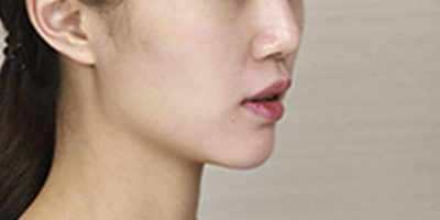 玻尿酸豐蘋果肌術(shù)前