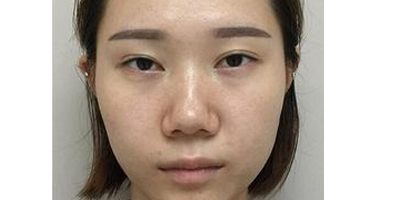 鼻中隔軟骨隆鼻術(shù)前