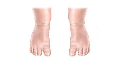 足內(nèi)翻矯正術(shù)后