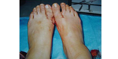 大腳骨矯正術(shù)后