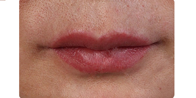 麗芙莎EPT自體抗衰術(shù)后