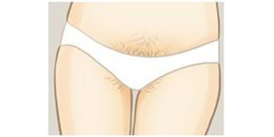 比基尼線脫毛術(shù)前