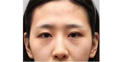 膠原蛋白豐淚溝術(shù)前