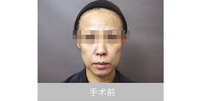 自體脂肪存儲術前