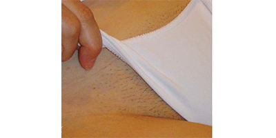 私密脫毛術(shù)前