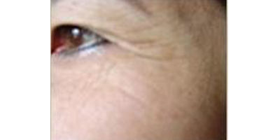 玻尿酸去靜態(tài)紋術(shù)前