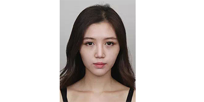 玻尿酸豐蘋果肌術(shù)前