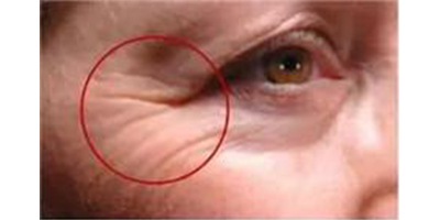 膠原蛋白注射術前