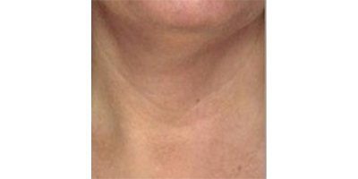 玻尿酸去頸紋術(shù)前