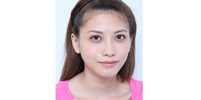 玻尿酸墊下巴術后