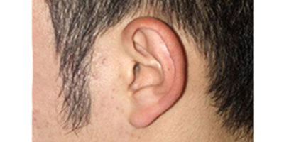 種植鬢角術(shù)后