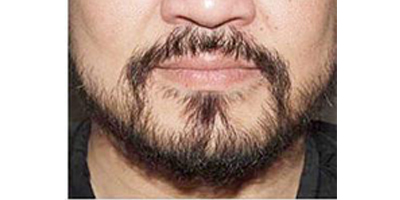 種植胡須術(shù)后