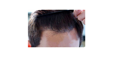 種植發(fā)際線術(shù)后