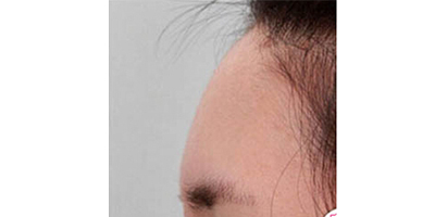 玻尿酸豐額頭術(shù)后