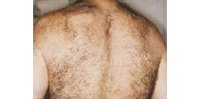 背部脫毛術(shù)前